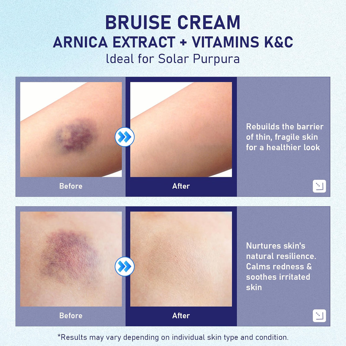 BRUISE REPAIR & SKIN CREAM WITH ARNICA, VITAMIN K, CALENDULA 4OZ SOOTHES/HEALS