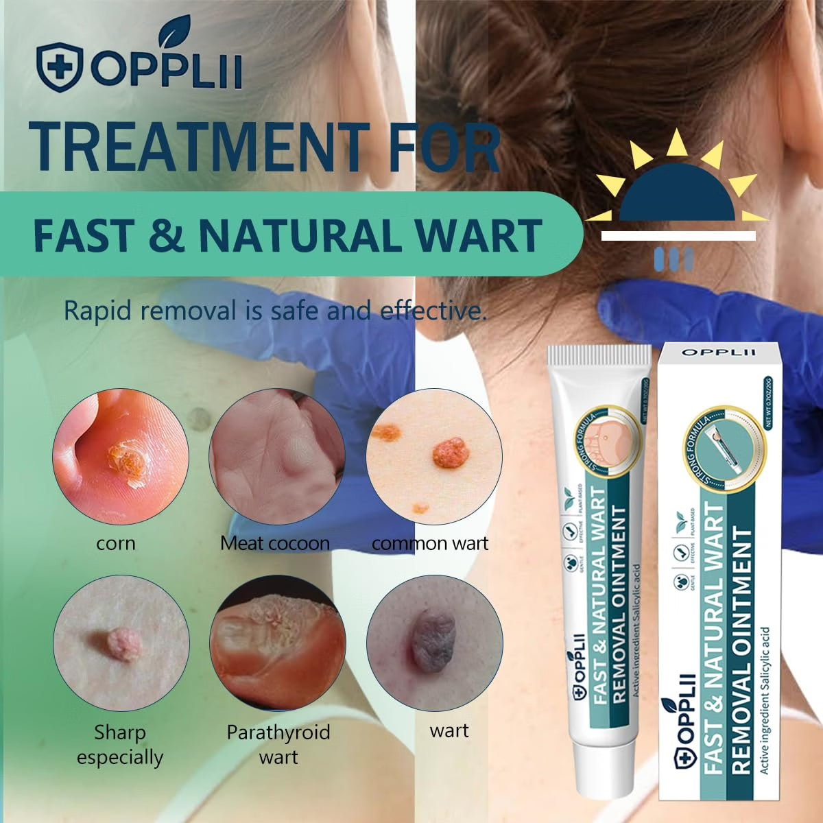 OPPLII FAST & NATURAL WART REMOVAL OINTMENT WITH 17% SALICYLIC ACID EXP. 2028