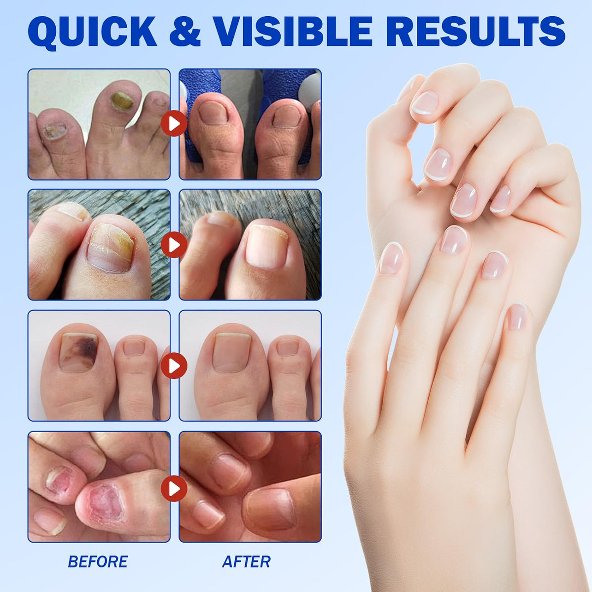 FUNGAL NAIL PATCHES 21PCS EXTRA STRENGTH OVERNIGHT HYDROGEL REPAIR